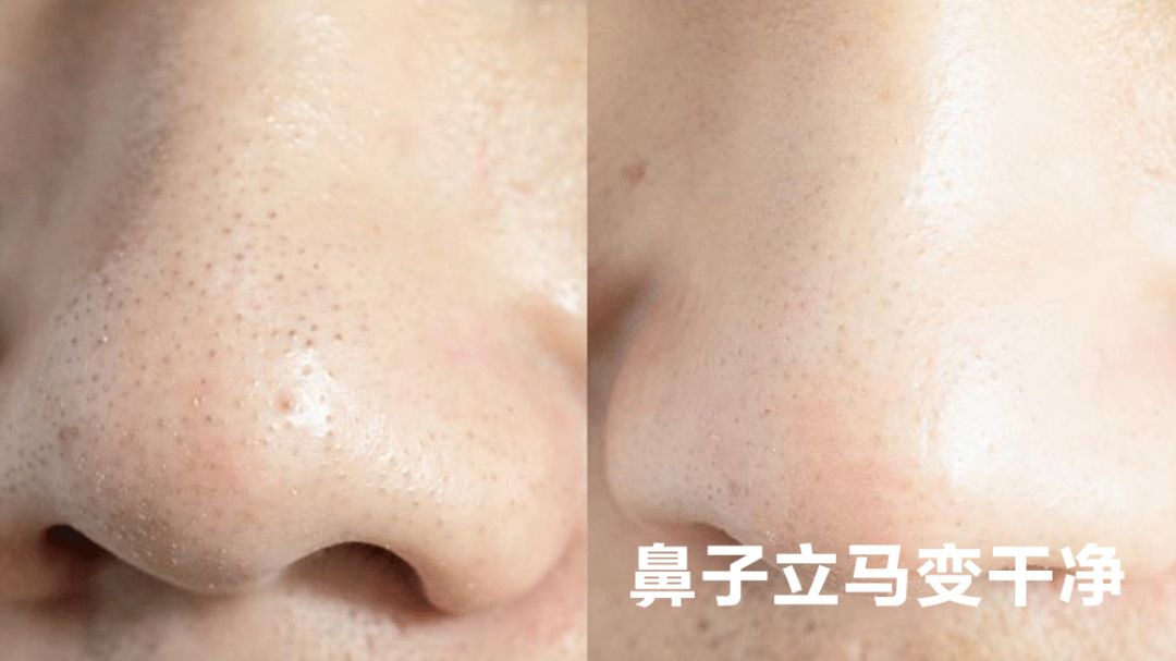 探索未来美容科技奇迹，最新款鼻子的魅力与影响力