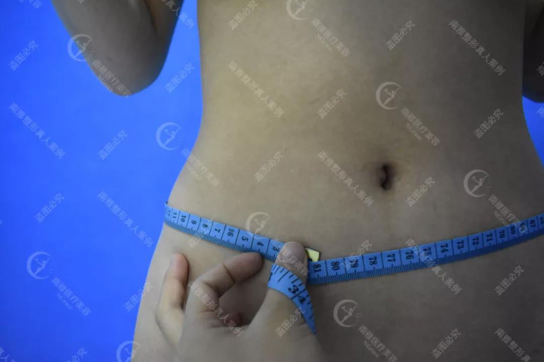 最新吸脂技术，重塑身材的革命性方法